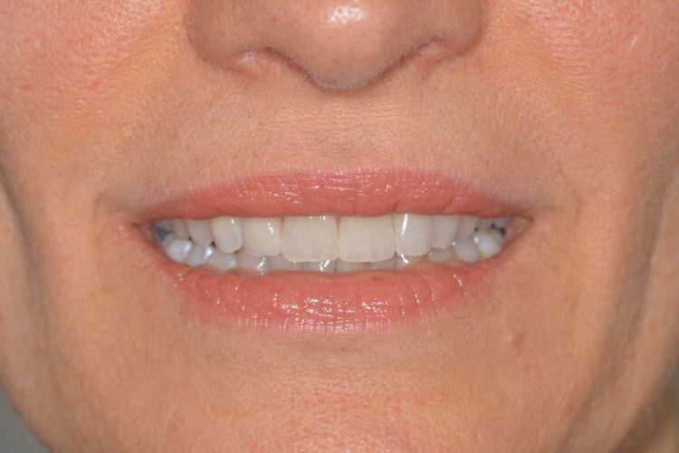 Ortodonzia Allineatori Caso Clinico1 Dopo7