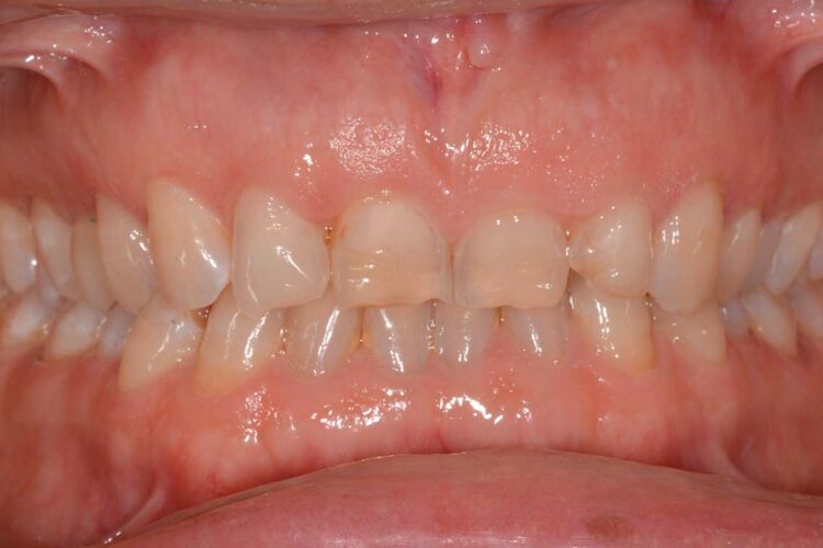 Ortodonzia Allineatori Caso Clinico1 Prima1