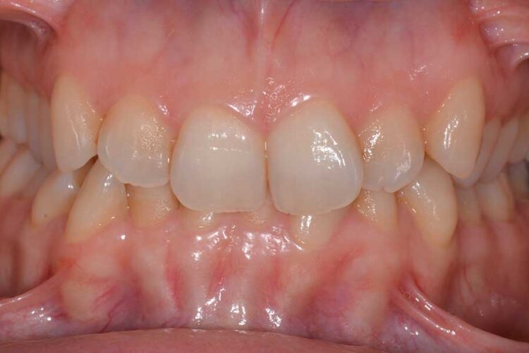 Ortodonzia Allineatori Caso Clinico1 Prima1