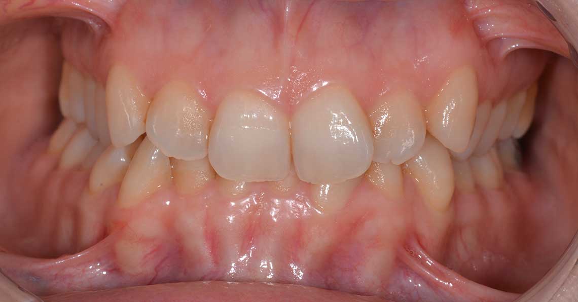 Ortodonzia Allineatori Caso Clinico1 Prima1