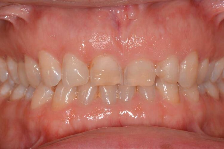 Ortodonzia Allineatori Caso Clinico1 Prima2