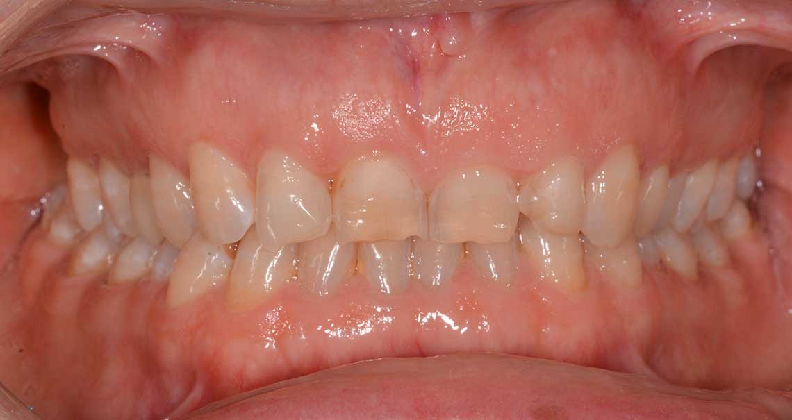 Ortodonzia Allineatori Caso Clinico1 Prima2