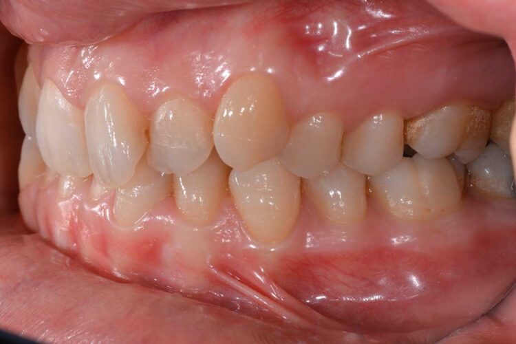 Ortodonzia Allineatori Caso Clinico1 Prima2