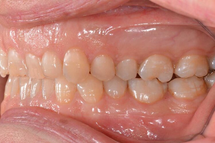 Ortodonzia Allineatori Caso Clinico1 Prima3