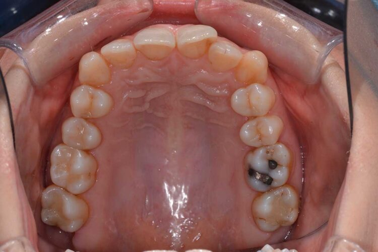 Ortodonzia Allineatori Caso Clinico1 Prima4