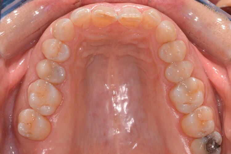 Ortodonzia Allineatori Caso Clinico1 Prima5