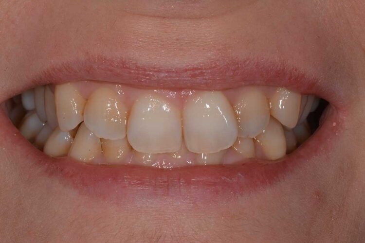 Ortodonzia Allineatori Caso Clinico1 Prima6