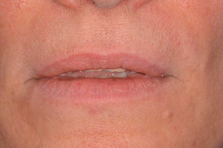 Ortodonzia Allineatori Caso Clinico1 Prima7