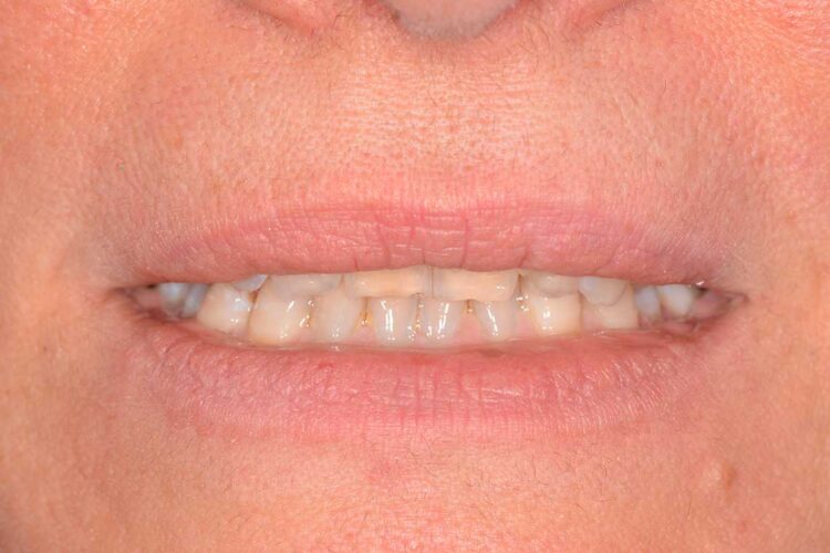 Ortodonzia Allineatori Caso Clinico1 Prima8