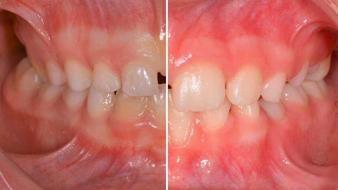 Ortodonzia Intercettiva Adulto Caso Clinico1