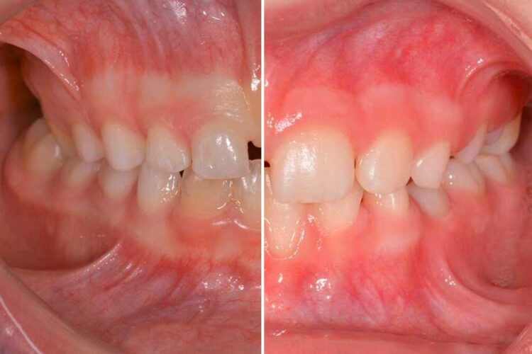 Ortodonzia Intercettiva Adulto Caso Clinico1