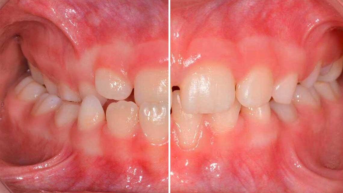 Ortodonzia Intercettiva Adulto Caso Clinico2