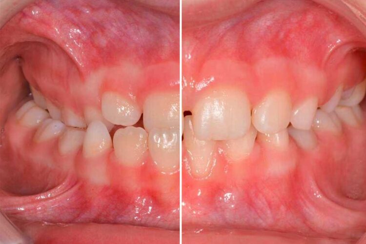 Ortodonzia Intercettiva Adulto Caso Clinico2