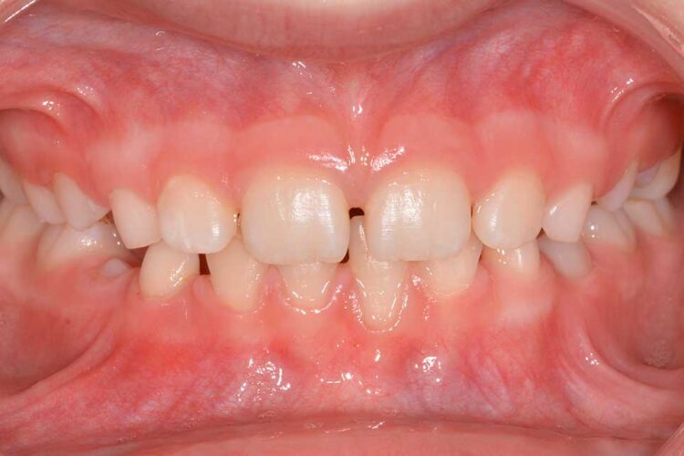 Ortodonzia Intercettiva Caso Clinico 1 Dopo1