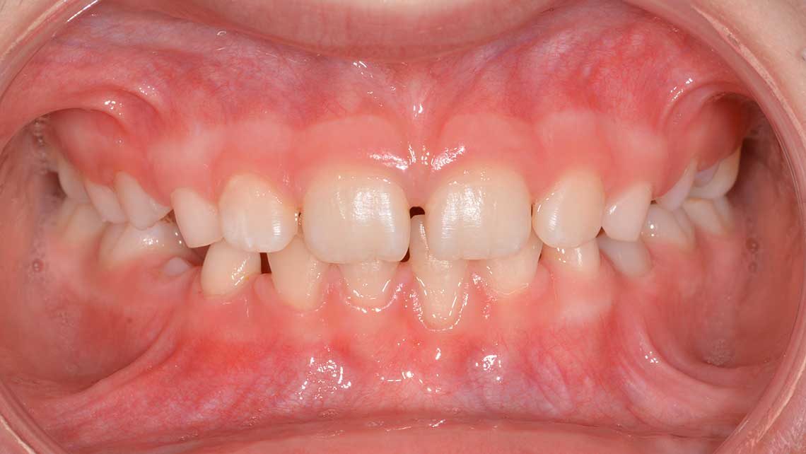 Ortodonzia Intercettiva Caso Clinico 1 Dopo1