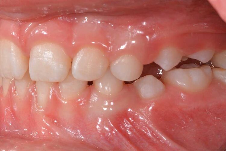 Ortodonzia Intercettiva Caso Clinico 1 Dopo2