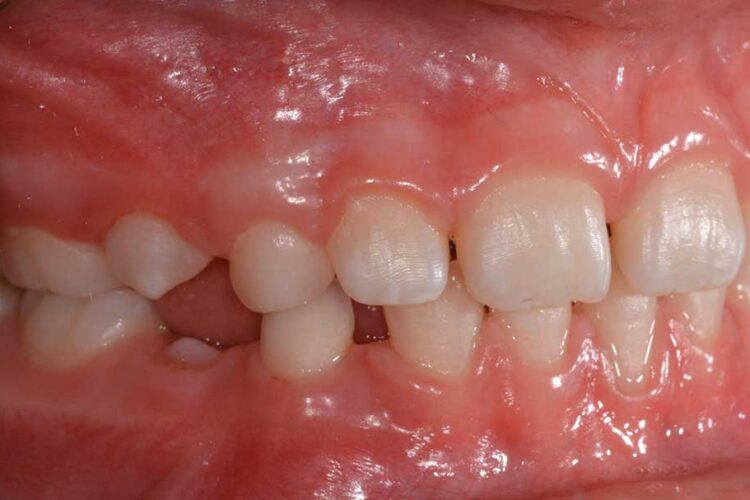 Ortodonzia Intercettiva Caso Clinico 1 Dopo3