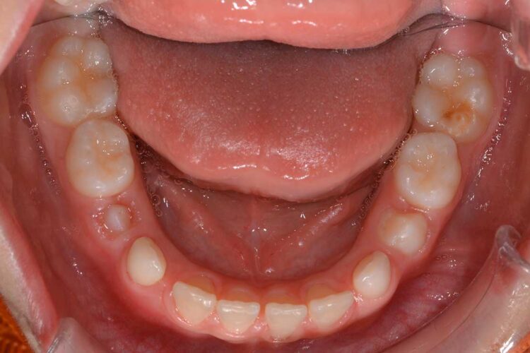 Ortodonzia Intercettiva Caso Clinico 1 Dopo5