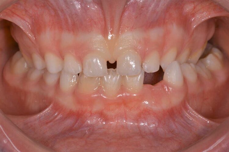 Ortodonzia Intercettiva Caso Clinico 1 Prima1