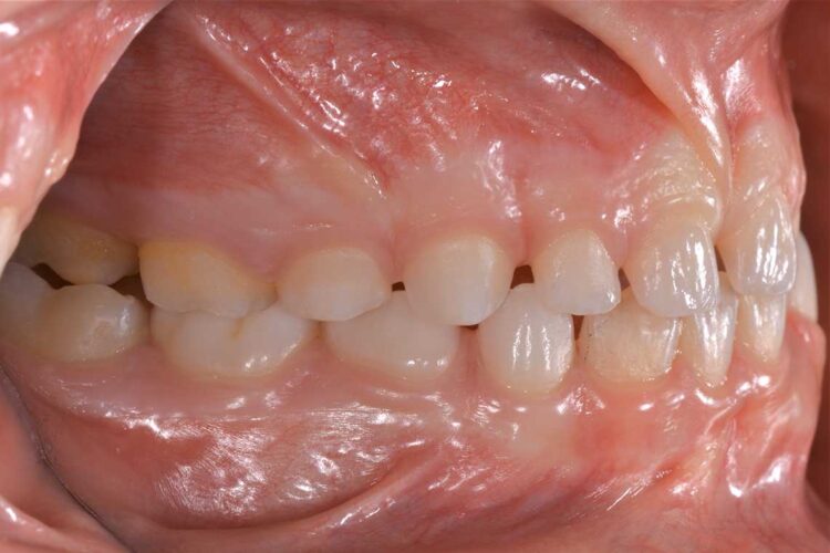 Ortodonzia Intercettiva Caso Clinico 1 Prima3