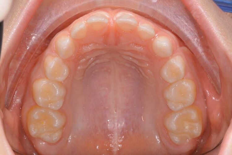 Ortodonzia Intercettiva Caso Clinico 1 Prima4