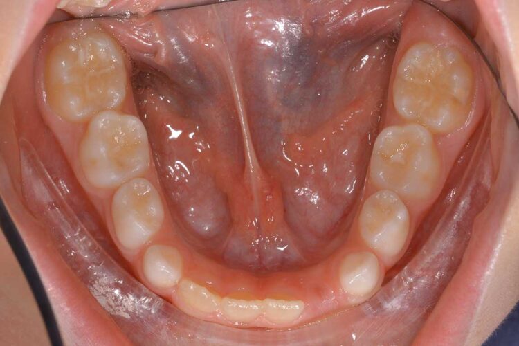 Ortodonzia Intercettiva Caso Clinico 1 Prima5