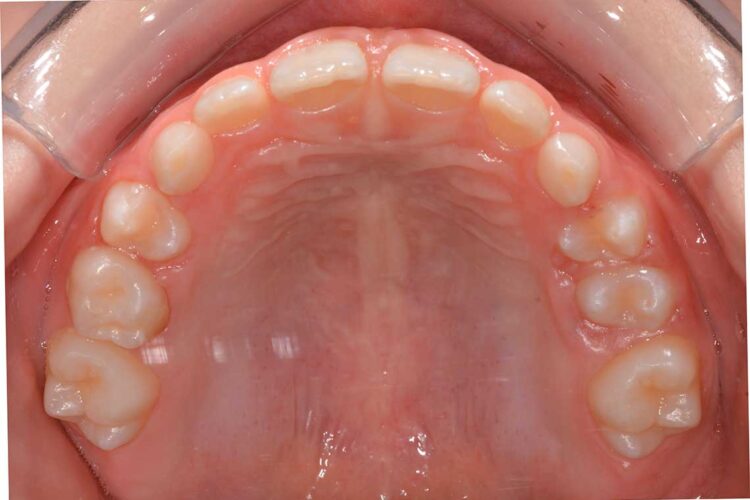 Ortodonzia Intercettiva Caso Clinico2 Dopo4