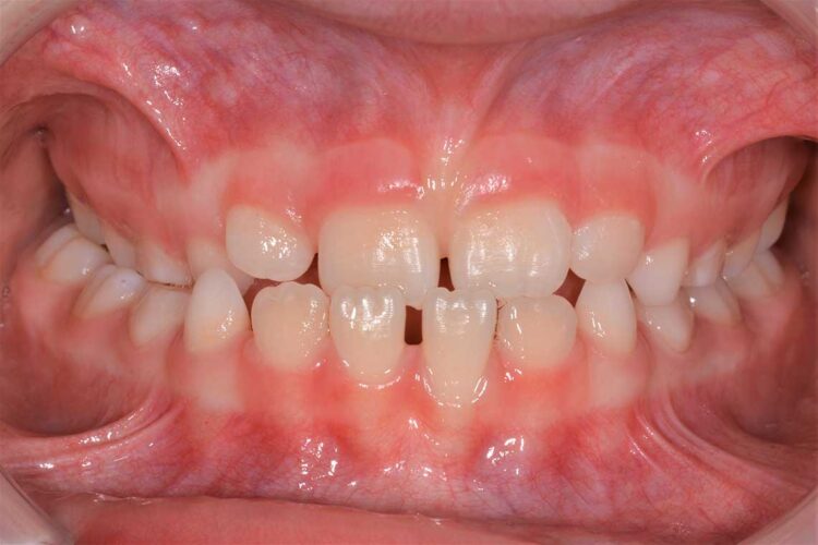 Ortodonzia Intercettiva Caso Clinico2 Prima1