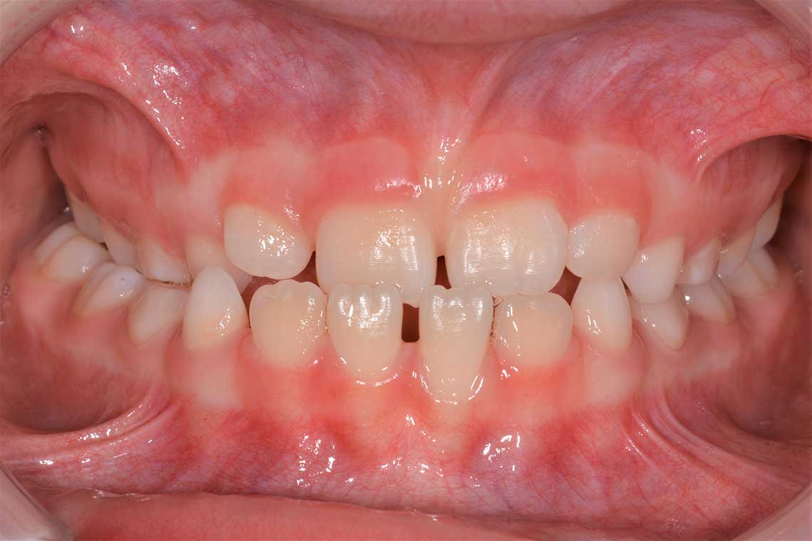 Ortodonzia Intercettiva Caso Clinico2 Prima1