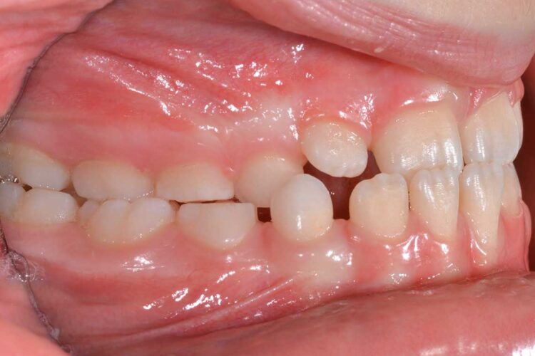 Ortodonzia Intercettiva Caso Clinico2 Prima3