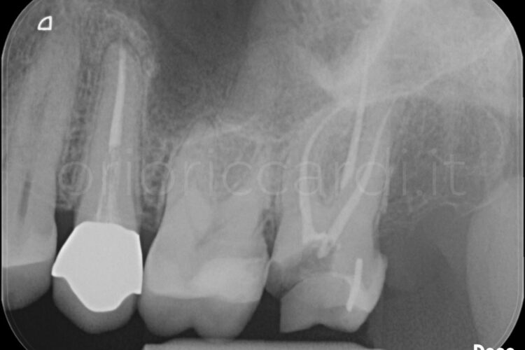 Cura Endodontica Dopo