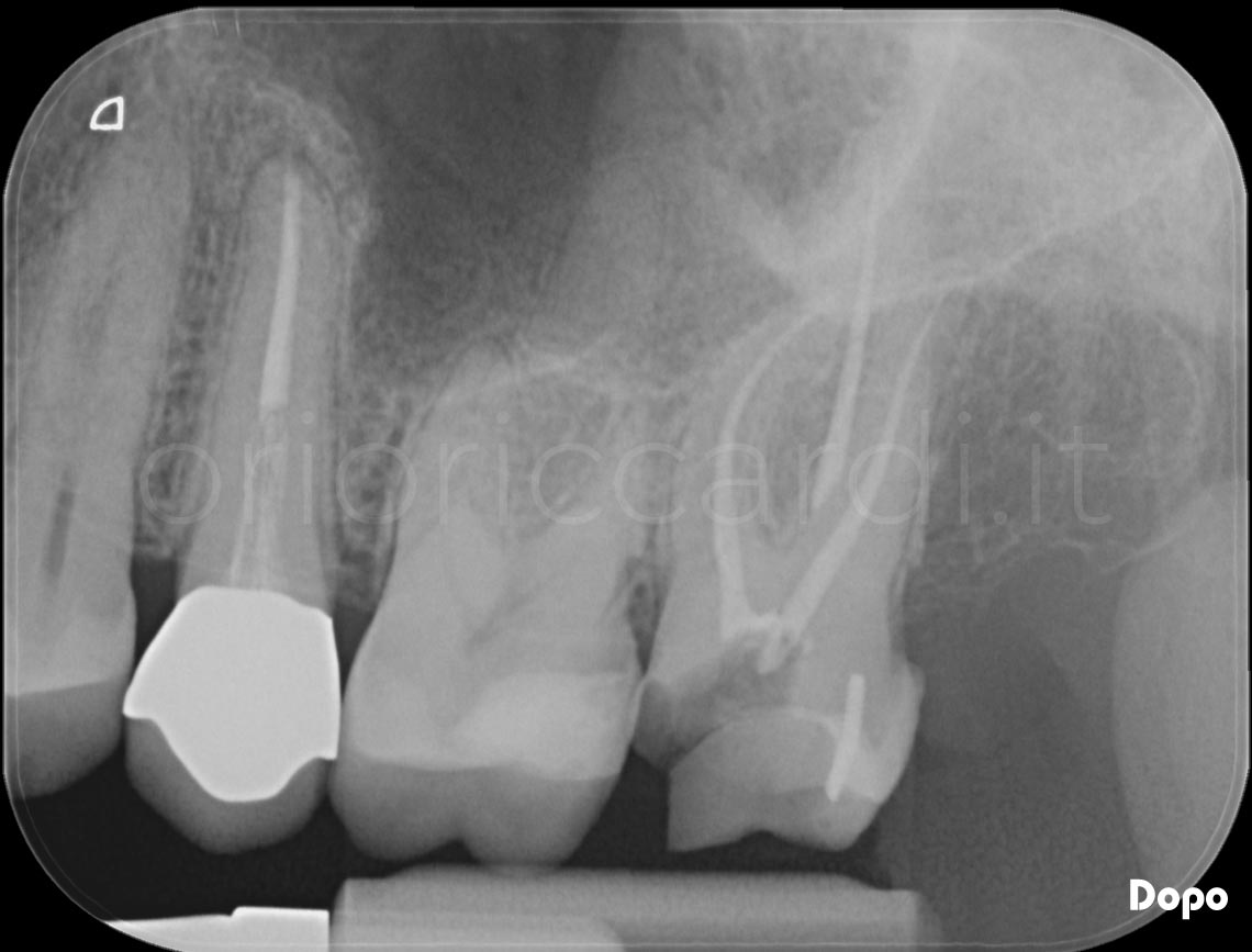 Cura Endodontica Dopo